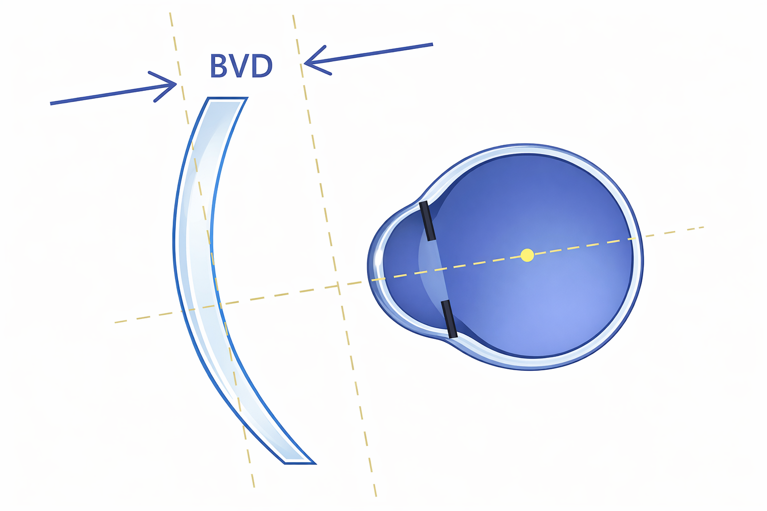 BVD 後頂點距離示意圖